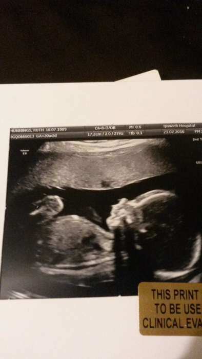 Our son at twenty weeks.