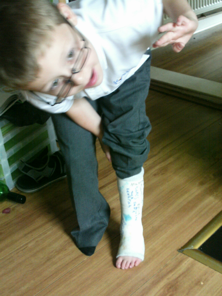 Mason shows off his new plaster cast.